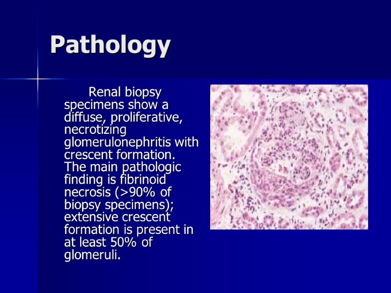 Pathology   Renal biopsy specimens show a diffuse, proliferative, necrotizing glomerulonephritis with crescent